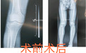 虐心！术后感染，DIP 超了 1 万多！主任：无法申诉，只能自己担…