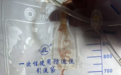 患者呕吐入院，大三甲主任却惊呼：是因为心脏长了虫，已潜伏三年