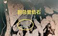 93岁婆婆胆管结石引发高烧腹痛“警报”，医生妙用微创ERCP技术“精准拆弹”