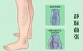 科普｜蚯蚓腿，红血丝背后的秘密