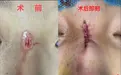 曾经一张缝合图遭 21 万同行怒批：草菅人命！患者术后 7 个月恢复却让人惊掉下巴