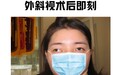 年龄不是问题！郑州普瑞眼科医院专家详解：成年人斜视矫正，任何时候都不算晚