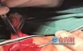 阿婆咽痛难忍 颈部取出一钢丝 家属怀疑是制作蛋糕时将清洁用的钢丝球碎片混入食材，导致误食