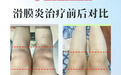 滑膜炎特色疗法：可视超导介入技术+免疫调节，助力关节祛痛消肿，防止复发