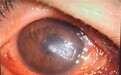 突发视力下降+眼痛？郑州普瑞眼科医院：警惕角膜感染，24小时急诊