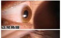 圆锥角膜患者必看！郑州普瑞眼科医院揭秘RGP眼镜与角膜塑形镜区别