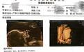 女子称彩超漏诊婴儿唇裂，到卫健委反映问题竟遭怒斥，涉事医院：彩超未看出任何问题