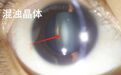 东莞光明眼科医院近视手术&白内障手术只能“二选一”？