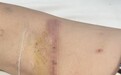 拖把池侧翻割断男童肌腱，医院：踩倒的，家属：自己倒的