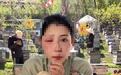 养蜂现场直播卖蜂蜜，女主播被蜇伤，一只眼红肿紧闭