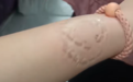 女子乘火车卧铺被占，争吵中手腕被咬起疱疹，当事人：怕对方有传染病
