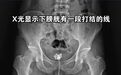 男子往尿道塞25厘米数据线，硬撑12小时