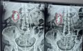 花甲老人右肾长满结石险丢肾功能，云南结石病医院微创取石手术化险为夷