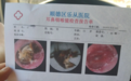 33岁男子睡梦中被蟑螂钻进耳道，近一周后才就医；医生：在耳道见蟑螂残体，左耳耳膜险些穿孔