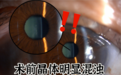 佛山爱尔眼科成功为八旬老人实施飞秒激光白内障联合三焦点晶体手术，术后视力达1.0