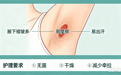 权威发声｜腋臭术后修复膜：既非“神药”，也非“多余”