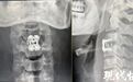 27岁男子按摩店正骨，“咔咔”瞬间失去知觉！医生：极可能致终身残疾