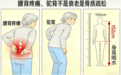 腰酸背痛、身高变矮并非老了！专家支招骨质疏松管理方法