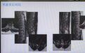 一觉醒来，30岁男子双下肢瘫痪、大小便失禁