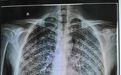 28 岁小伙突然发疯，看完片子主任直呼这么经典很少见