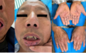 双手被「泼墨」，狂搓不掉！检测却一切正常？主任：罕见中的罕见，直接发刊