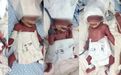 24岁新疆妈妈产下5胞胎（1男4女），最重1030克最轻870克