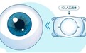 ​聊城爱尔眼科医院引进新一代EVO+ ICL（V5）晶体，专属预约通道正式开启