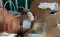 河南被绳索割伤气管男孩已转出ICU 水滴筹：已筹满60万、提现近35万
