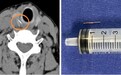 “吞饭团去鱼刺”可能很凶险，医生手术取出甲状腺中的鱼刺