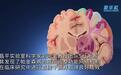 中国科学家世界首次发现帕金森病底层功能网络机制