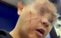 愤怒！香港又有休班警员遇袭 脸上被刀划“十字”伤口