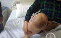 河南杞县115人针灸后皮肤溃烂 医生被警方带走
