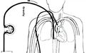 成功救治1名新型肺炎患者的ECMO为何方神圣？