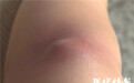 女子胳膊被蚊子咬了个包 医生一看：赶紧做手术