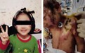 6岁女童遭亲妈及男友虐待险丧命 生父：光骨折几十处