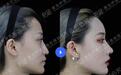 青岛伊美尔鼻综合：整体调整，多方面改善鼻部问题