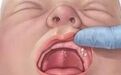 西安市中心医院：新生儿口腔的那些事