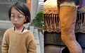 云南8岁女童疑遭继母虐待：没写完作业被打肿双眼 多部门介入调查