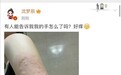沈梦辰深夜胳膊红肿起巨大包块 网友直呼太吓人