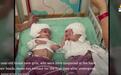 1岁头部相连双胞胎成功手术分开 出生后首次对视