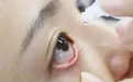 交感性眼炎手把手教您 如何在家自己护理？