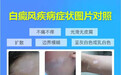 成都西部白癜风医院：六项普查0元活动12月18日即将开启，速约！