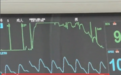 男子住院把心电监测仪玩明白了：在心电图上“画长城”