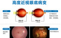 高度近视戴眼镜也模糊 精准EVO—ICL人工晶体植入重返高清视界
