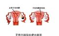潍坊市人民医院|乱跑的子宫内膜