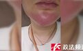 女子投诉洁牙后毁容 岳麓区卫健部门突查涉事诊所