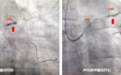 南京鼓楼医院心血管内科成功完成一项全新冠脉介入治疗技术