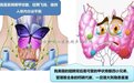 超声医师用热消融解决甲状旁腺功能亢进