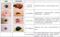 “好声音”张恒远因病去世 “黑色素瘤”究竟是什么？
