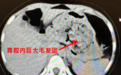 孩子爱吃头发？小心患上“长发公主综合征”！